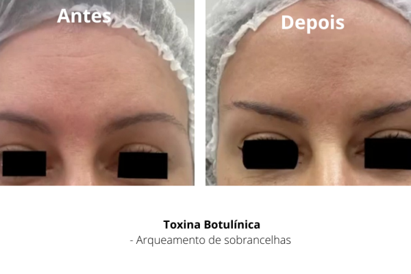 toxina botulinica arqueamento de sobrancelhas